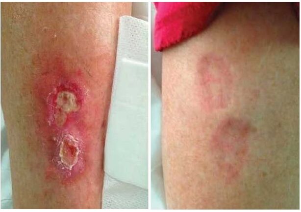 Glukonoli auttoi pääsemään eroon diabeettisista haavaumista